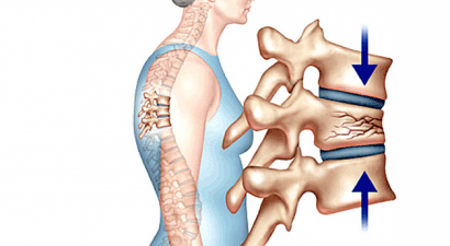 ĐIỀU TRỊ BỆNH VỠ CỘT SỐNG AN TOÀN HIỆU QUẢ CAO.